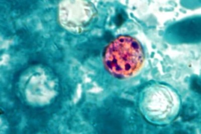 FDA reports new outbreak of explosive diarrhea with 72 cases identified