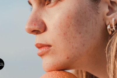How to get rid of blemishes: A practical guide for clearer skin